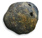 Tuber Excavatum